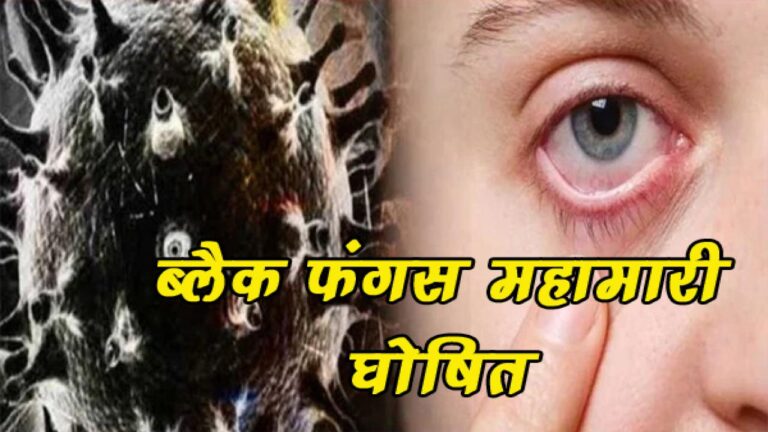 हिमाचल में अब ब्लैक फंगस महामारी घोषित