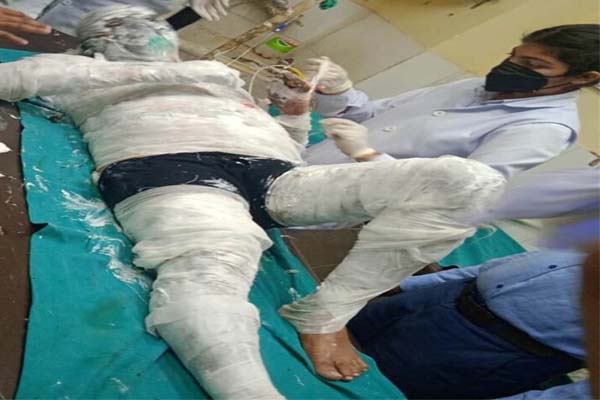 ऊना: जंगल की आग बुझाते हुए चपेट में आया वनरक्षक, गंभीर हालत में PGI रेफर