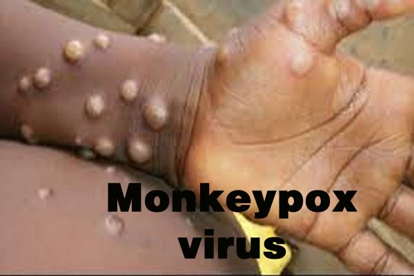 मंकीपॉक्स वायरस: भारत सतर्क, स्वास्थ्य मंत्रालय ने जारी की गाइडलाइंस