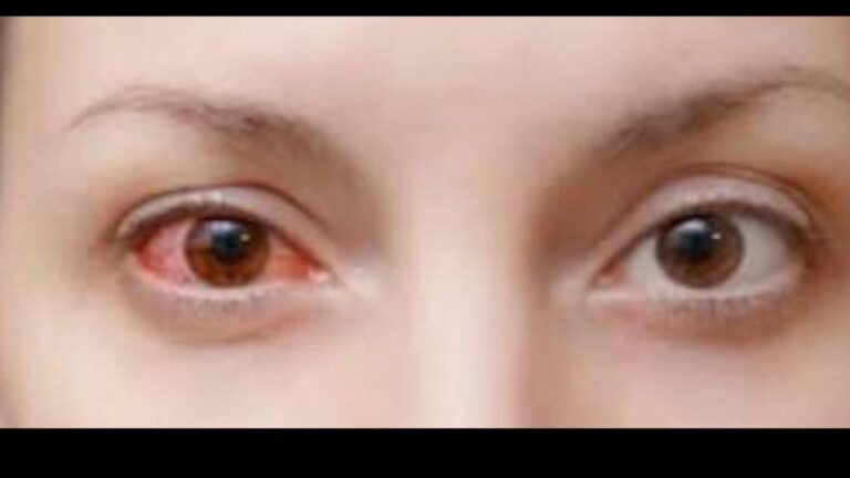 तेलका में आई फ्लू का प्रकोप, सात दिनों में सामने आए संक्रमण के 100 मामले; रोज 10 से 15 लोग पहुंच रहे अस्पताल