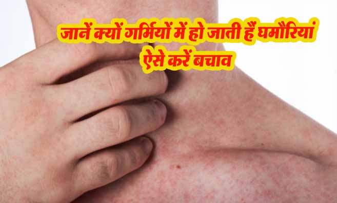 Natural remedies for heat rashes