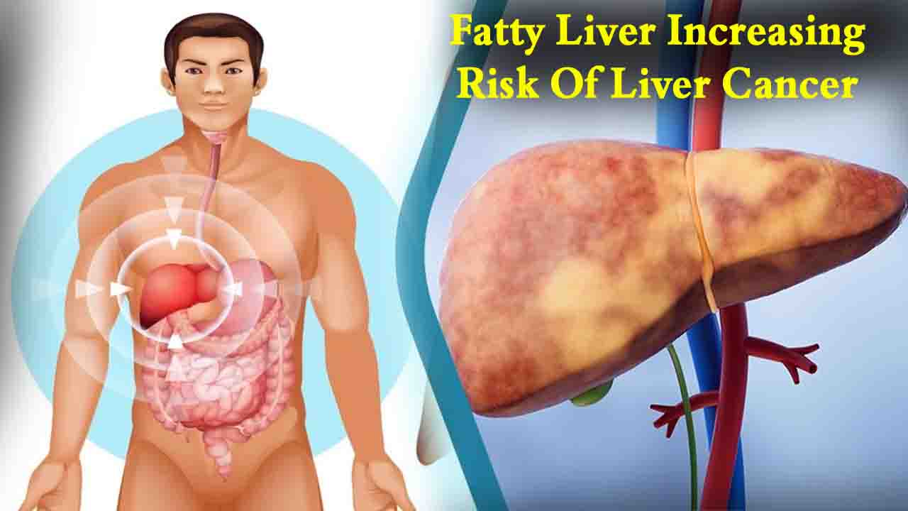 Fatty Liver: फैटी लिवर से बढ़ रहा है लिवर कैंसर का खतरा, समय रहते अपनाएं ये आसान उपाय