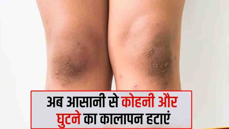 Knee Darkness: घुटनों का कालापन दूर करने के आसान घरेलू नुस्खे - शहनाज़ हुसैन
