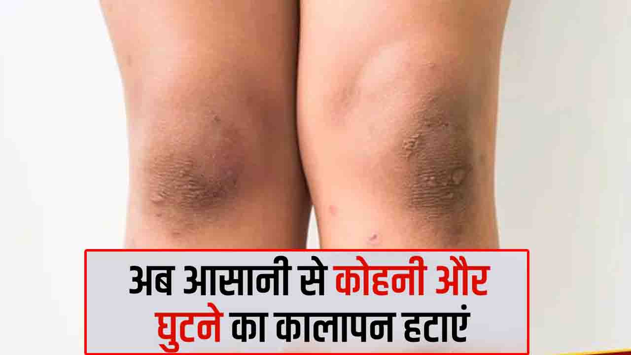 Knee Darkness: घुटनों का कालापन दूर करने के आसान घरेलू नुस्खे - शहनाज़ हुसैन