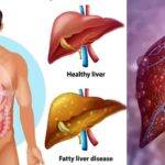 क्या दुबले-पतले लोगों को भी हो सकती है फैटी लिवर की बीमारी? जानिए मुख्य कारण