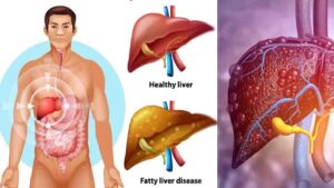 Fatty Liver Symptoms क्या दुबले-पतले लोगों को भी हो सकती है फैटी लिवर की बीमारी? जानिए मुख्य कारण