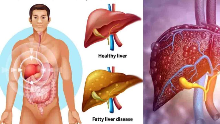 Fatty Liver Symptoms क्या दुबले-पतले लोगों को भी हो सकती है फैटी लिवर की बीमारी? जानिए मुख्य कारण