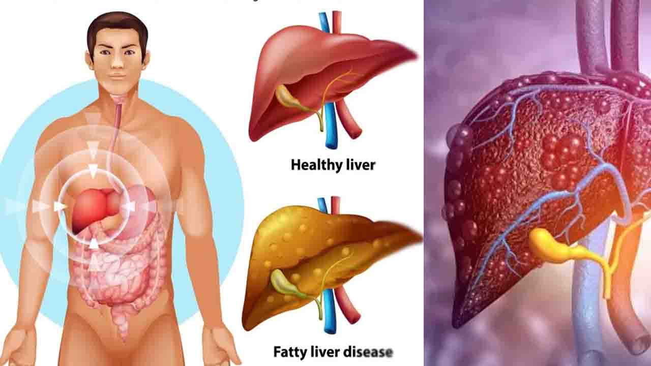 Fatty Liver Symptoms क्या दुबले-पतले लोगों को भी हो सकती है फैटी लिवर की बीमारी? जानिए मुख्य कारण
